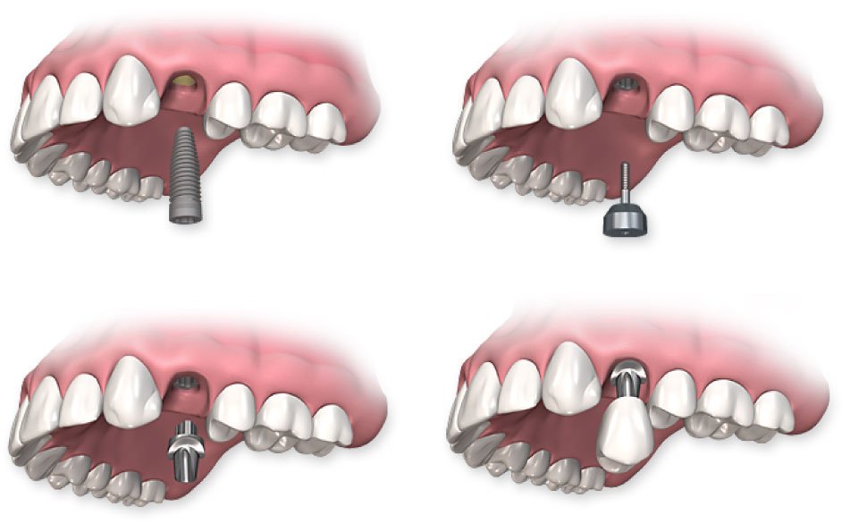 Edmonds Dental Implants