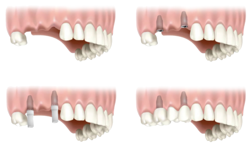 Edmonds Dental Implants