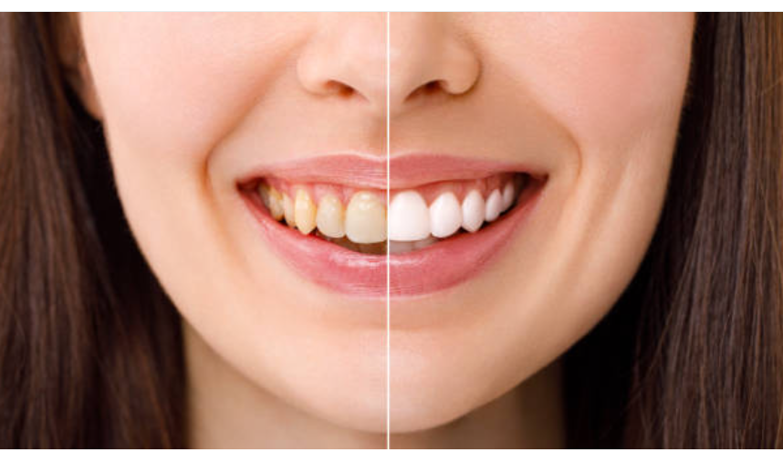 Teeth whitening